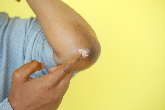 Close up of man hand applying petroleum jelly on his elbow photo