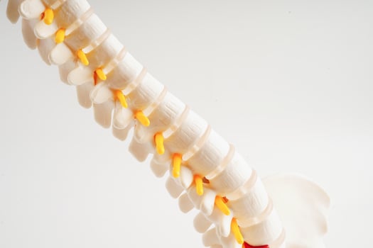 Spinal nerve and bone, Lumbar spine displaced herniated disc fragment, Model for treatment medical in the orthopedic department. photo