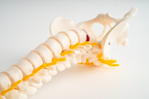 Lumbar spine displaced herniated disc fragment, spinal nerve and bone. Model for treatment medical in the orthopedic department. photo