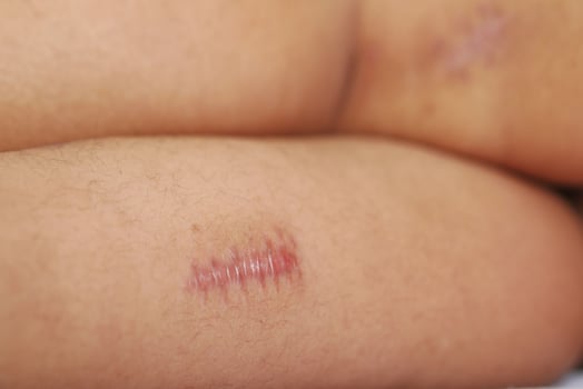 Stitched wound mark on a child foot. photo