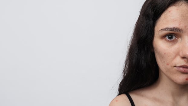 A large portrait of a young woman with skin problems - pimples, acne, enlarged pores. A place for your text. photo