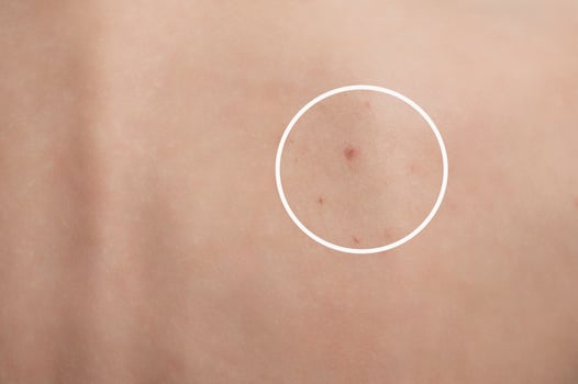 Close-up of the back skin of a woman with acne and other dermatological problems. photo
