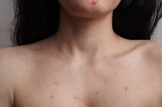 Close-up of the skin of the face and body of a woman with acne and other dermatological problems. photo