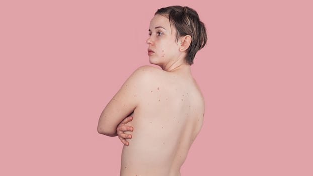 A woman's body with numerous moles. Prevention of skin Cancer. The panorama. A place for the text. photo