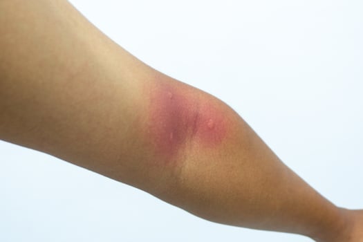 Insect bite on human skin. Swollen mosquito bite. man hand skin turned and scratching bitten photo