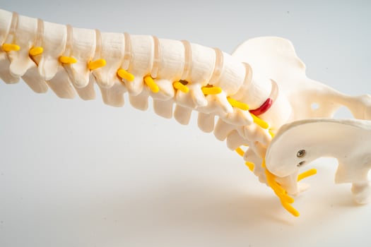 Lumbar spine displaced herniated disc fragment, spinal nerve and bone. Model for treatment medical in the orthopedic department. photo