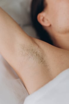 Sugaring. epilation with liquate sugar at armpit. photo