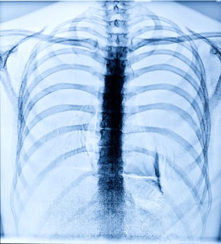 X Ray Image Of Human Chest photo