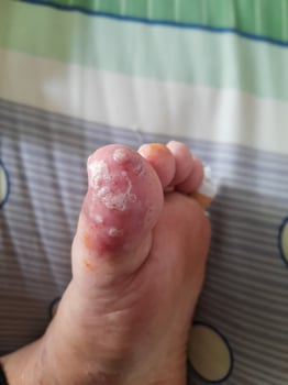Inflamed feet are caused by athlete's foot fungus infection photo