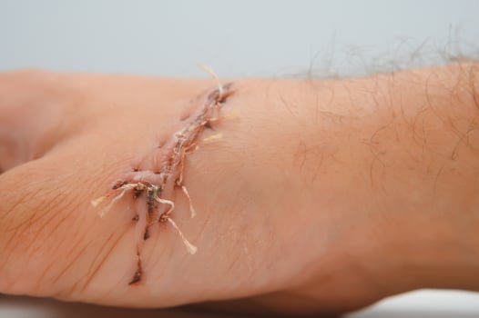 Suture wound on hand from dermatology procedure photo