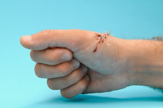 Suture wound on hand,Pain of accident concept photo