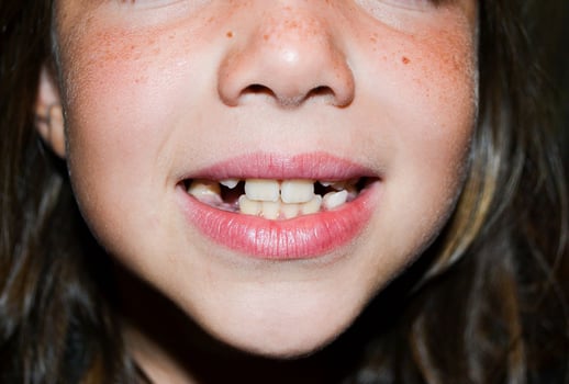 Closeup view of an adorable toddler girl smiling with two of her milk teeth missing. Wide view image. photo