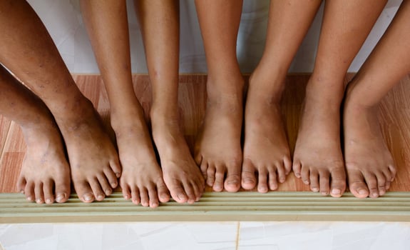 The feet and legs of children with skin diseases or uneven skin from dark spots caused by infections or various skin diseases. photo