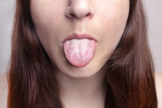 Woman shows a white tongue. A common symptom of a candida albicans yeast infection or stomatitis. health problems, mouth problems photo