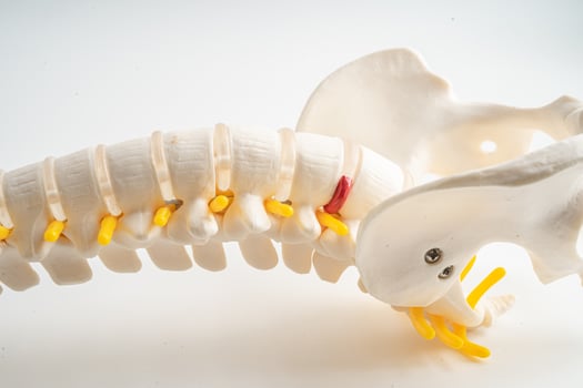 Lumbar spine displaced herniated disc fragment, spinal nerve and bone. Model for treatment medical in the orthopedic department. photo