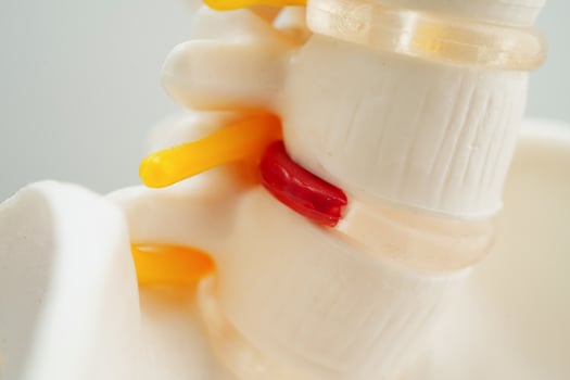 Spinal nerve and bone, Lumbar spine displaced herniated disc fragment, Model for treatment medical in the orthopedic department. photo