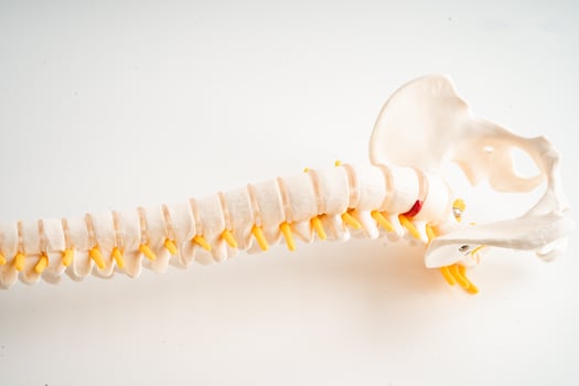 Lumbar spine displaced herniated disc fragment, spinal nerve and bone. Model for treatment medical in the orthopedic department. photo