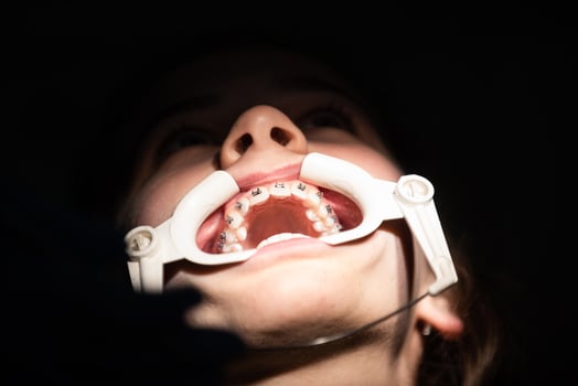 Close up of girl with brackets receiving dental braces treatment in clinic photo
