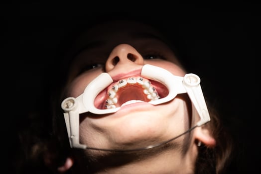 Close up of girl with brackets receiving dental braces treatment in clinic photo