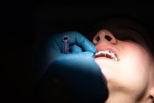 Close up of girl with brackets receiving dental braces treatment in clinic photo