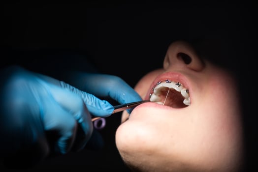 Close up of girl with brackets receiving dental braces treatment in clinic photo
