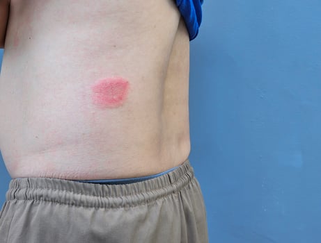 ringworm infection of the Body skin. copy space photo