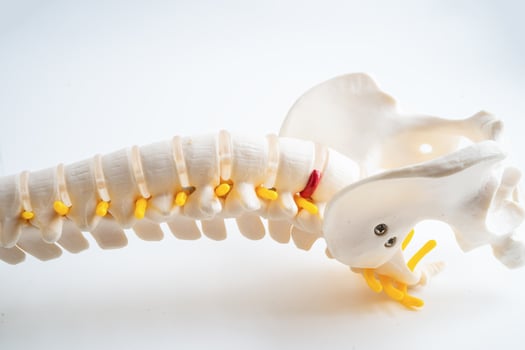 Lumbar spine displaced herniated disc fragment, spinal nerve and bone. Model for treatment medical in the orthopedic department. photo