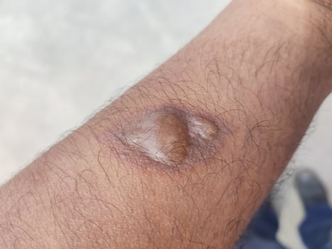 blistered skin due to exposure to hot objects resulting in burns to the skin photo