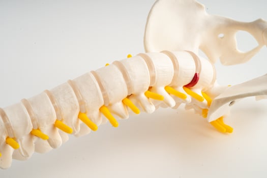 Lumbar spine displaced herniated disc fragment, spinal nerve and bone. Model for treatment medical in the orthopedic department. photo