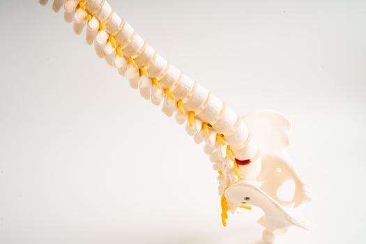 Lumbar spine displaced herniated disc fragment, spinal nerve and bone. Model for treatment medical in the orthopedic department. photo