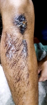 Boy was in an accident with a knee injury. The wound should be cleaned to prevent serious infections. photo