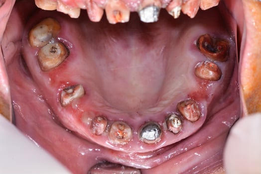 Close-Up of a Patients Mouth Showing Missing Teeth photo