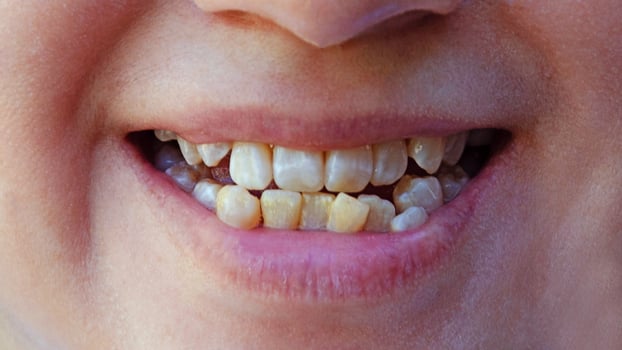 mouth woman with yellow sick and missing teeth, mouth of smoker, dentist's appointment and shows his damaged teeth before prosthetics, concept orthodontic and stomatology, Bad teeth. photo