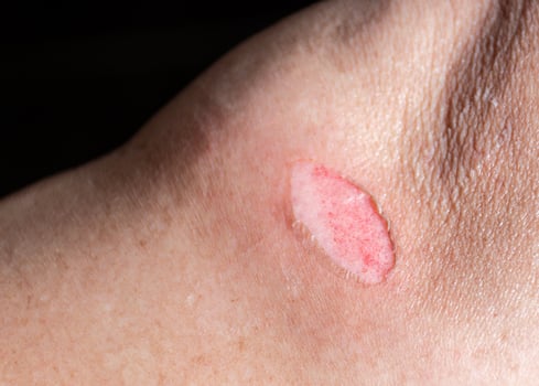 Close up scab on the legs photo