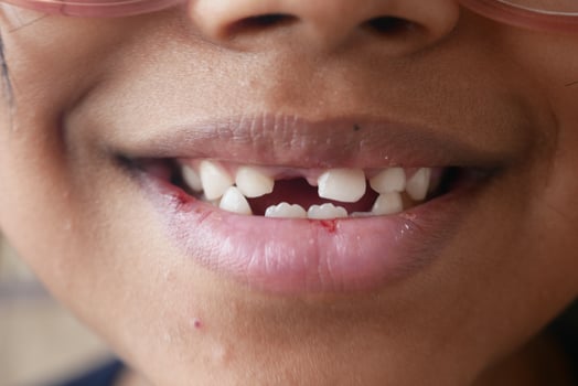 detail shot of child with teeth missing photo