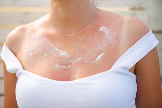 Woman with sunburned skin. Burn. photo