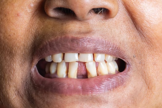 Close up of the teeth of a woman with a broken tooth. photo