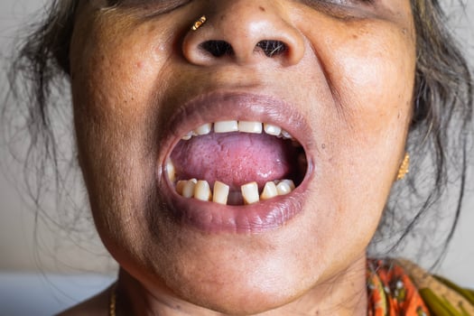 Close up of a woman's open mouth showing missing teeth. Dental problems photo