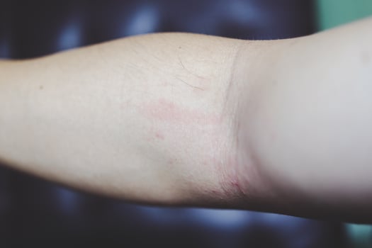 Allergic rash dermatitis eczema skin of patient. hand in scratching itchy, itch red spot or rash of skin. Healthcare. photo