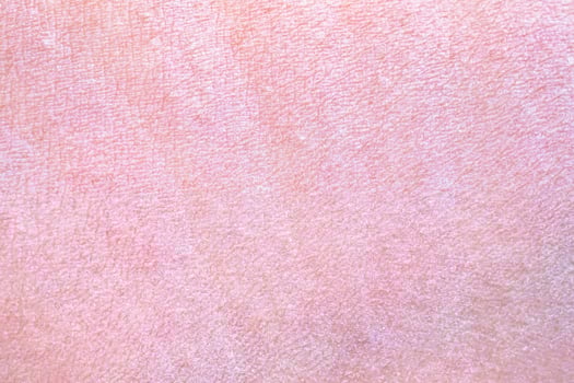 dry and dehydrated human skin texture background photo