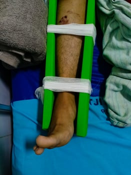 Asian man with broken leg at hospital, a leg bandaged with wood in hospital photo