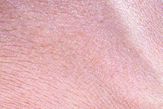 dry and dehydrated human skin texture background photo