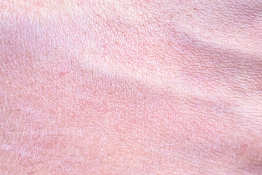 dry and dehydrated human skin texture background photo