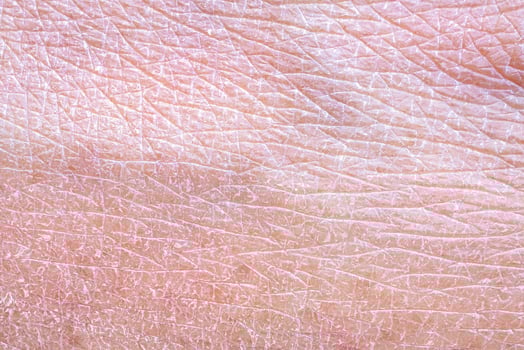 dry and dehydrated human skin texture background photo