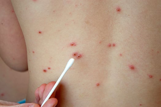 Natural vaccination. Contagious disease. photo