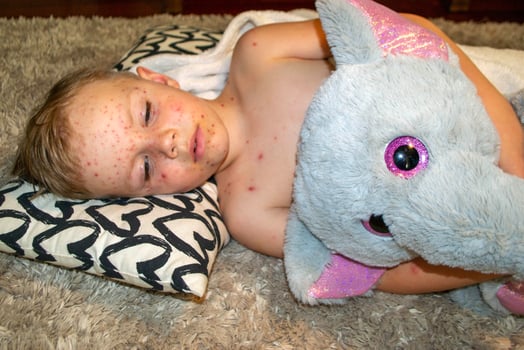 Natural vaccination. Contagious disease. photo
