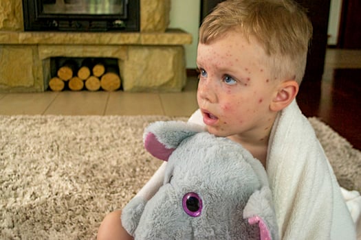 Natural vaccination. Contagious disease. photo