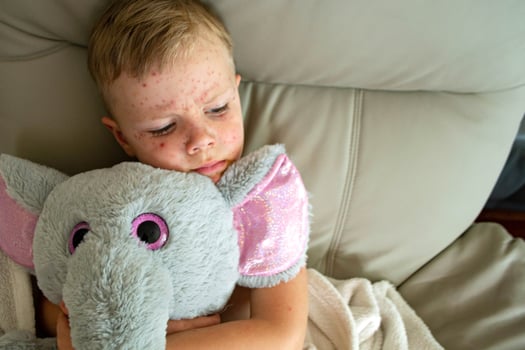 Natural vaccination. Contagious disease. photo