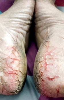 BROKEN HEEL SKIN of indian female in forties age. Cracked heels, also referred to as heel fissures, are a common foot condition, which can cause discomfort or even pain. photo
