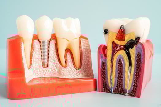 Dental implant, artificial tooth roots into jaw, root canal of dental treatment, gum disease, teeth model for dentist studying about dentistry. photo